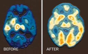 Pineal XT Before and After